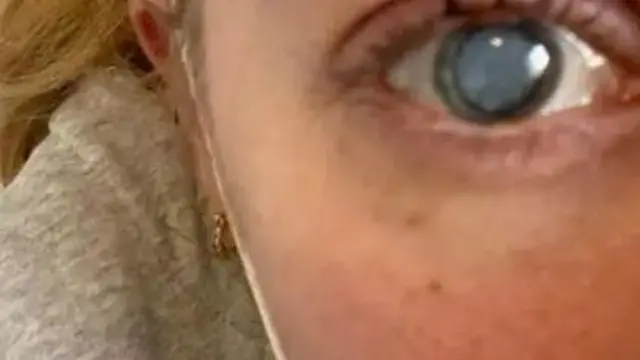 چشم الی دچار آب مروارید شد که باید جراحی می‌شد