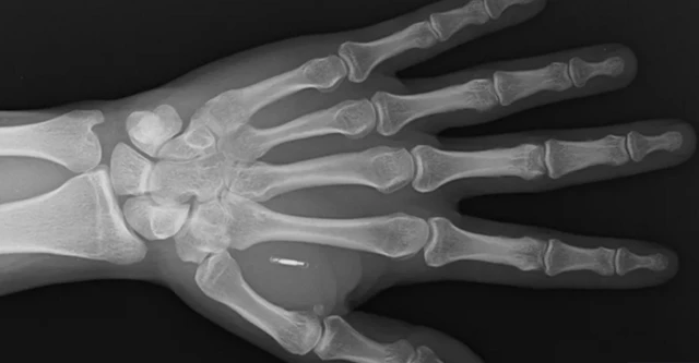 ለግብይት በቆዳ ሥር የተቀበረ ማይክሮቺፕ