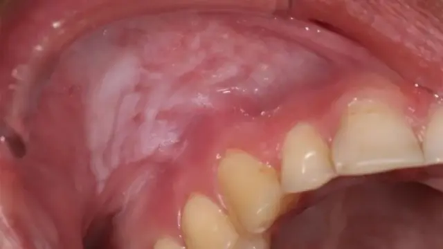 مسوڑھوں کو ہونے والے نقصانات بہت زیادہ نظر آ رہے ہیں