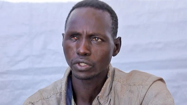 Мужчина, у которого поврежден или болен один глаз: вместо белка и зрачка там сплошная красная пленка.