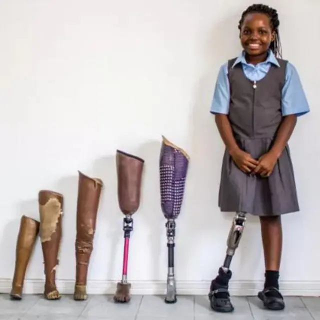 Àwòrán ọmọ tí kò ní ẹsẹ̀