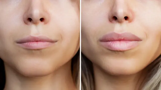 లిప్ ఫిల్లర్లు