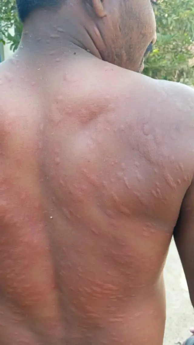 कापसातील किडींमुळे प्रशांत पोहरे यांच्या पाठीवर असे फोड आलेत.