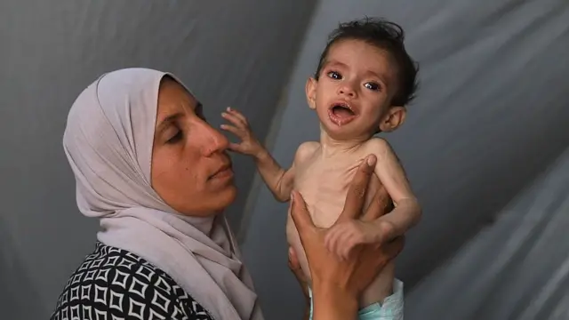 Zakariya, de 11 meses, visiblemente desnutrido, es sostenido por su madre