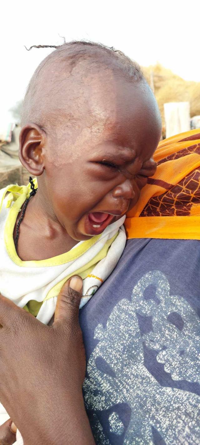 طفل يعاني من سوء التغذية