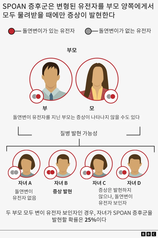 SPOAN 증후군은 변형된 유전자를 부모 양쪽에게서 모두 물려받을 때만 발현됨을 보여주는 그래픽