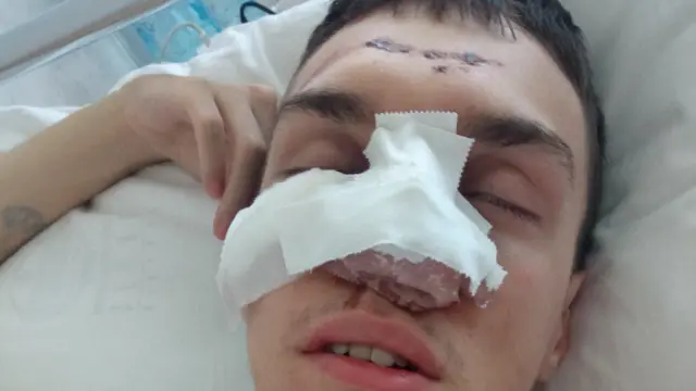 Luka Mihajlović, student novosadskog Fakulteta tehničkih nauka, zadobio je tri preloma kostiju glave posle intervencije Žandarmerije 28. juna u Beogradu