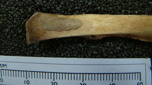 Remendo elevadoapostaaposta em jogo de basquetejogo de basqueteosso mais escuro e porosoaposta em jogo de basqueteuma costela