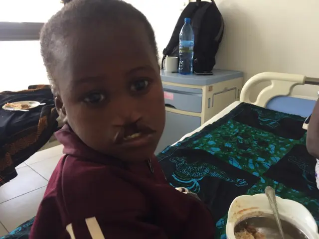 Mtoto mwenye tatizo la mdomo