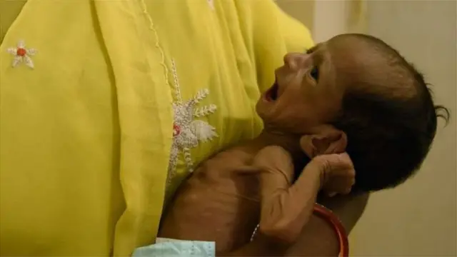 कुपोषित बच्चा