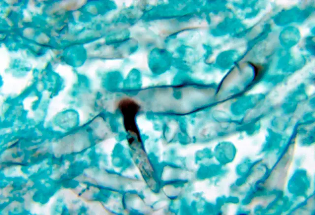 ब्लैक फ़ंगस