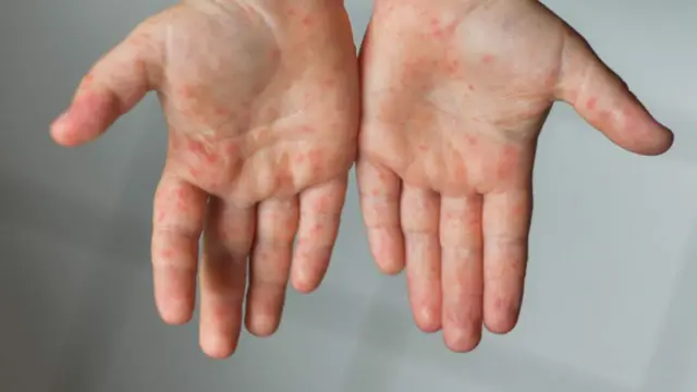 મુંબઈમાં ઓરીના કેસમાં વધારો