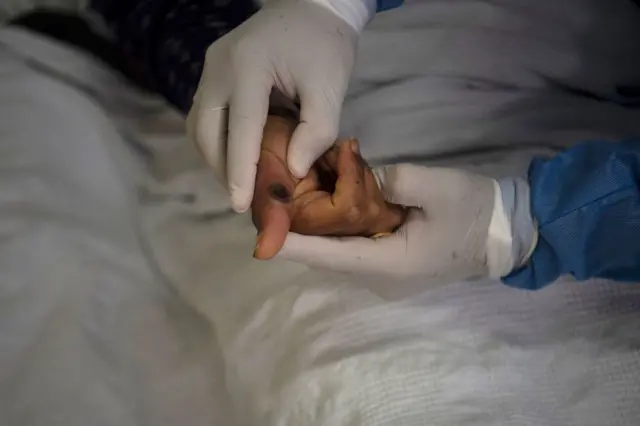 اصابة بالمرض