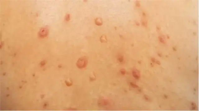 Ọrịa Monkey Pox