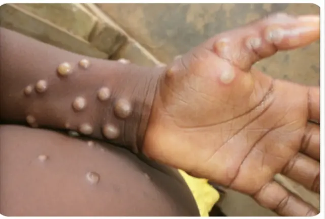 WHO akpọpụtala aha ọrịa a dịka ọrịa ụwa kwesịrị ilebara anya ngwa ngwa.