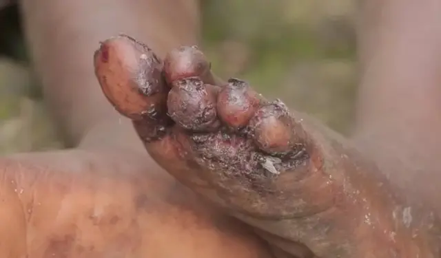 Funza katika vidole vya miguu ya mtoto mmoja katika Kijiji cha Kabazungu - wilaya ya Musanze