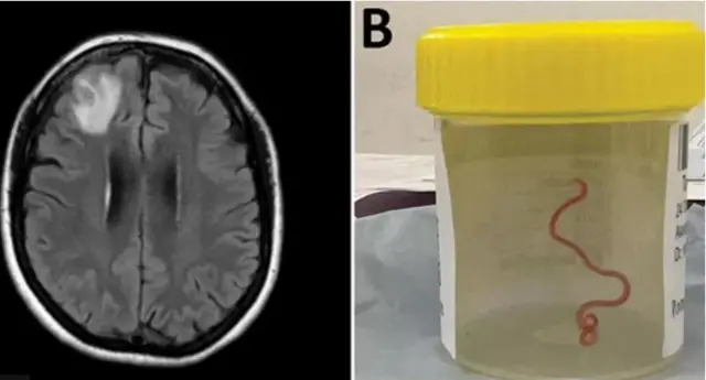 Okpo a hụrụ n'ime ụbụrụ otu nwaanyị