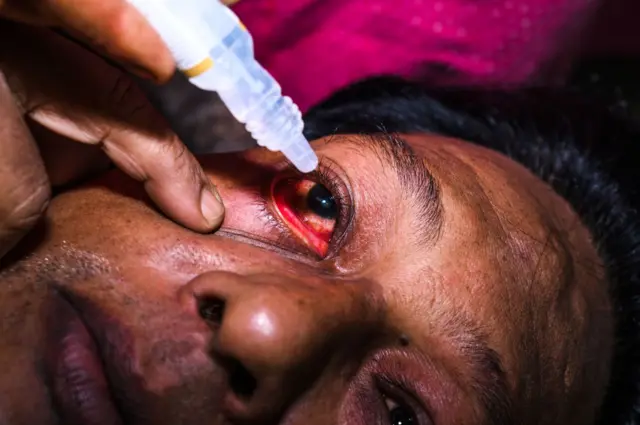 آشوب چشم کی علامات