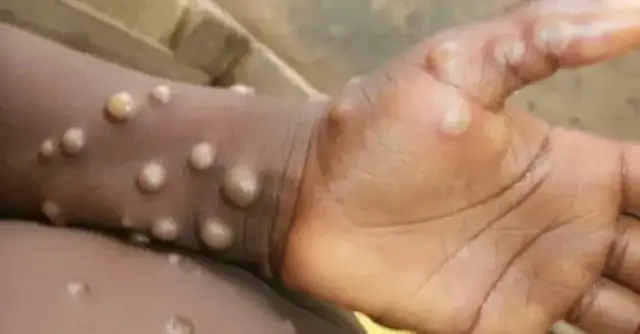 Njirimaara ọrịa Mpox
