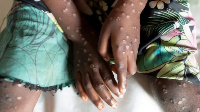 Onye nwere ọrịa Mpox