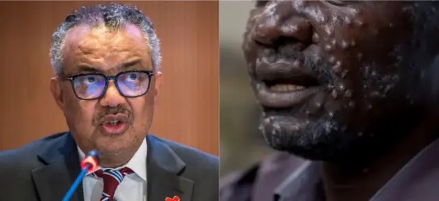 Tedros Adhanom Ghebreyesus na onye na-arịa ọrịa mpox