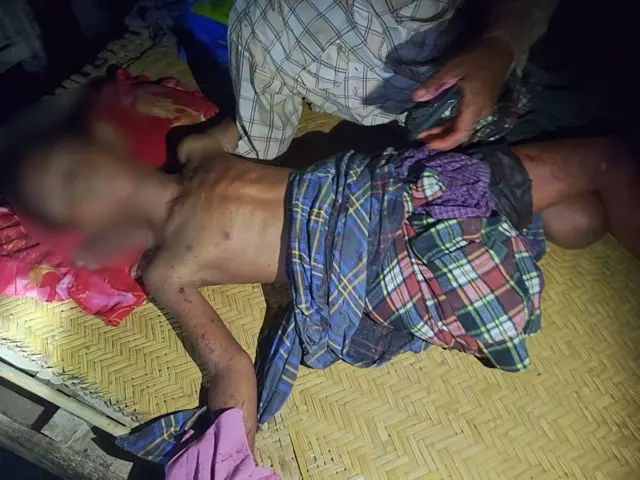 စက်တင်ဘာ ၁ ရက်၊ ညနေပိုင်းလေကြောင်းပစ်ခတ်မှုကြောင့် ခြေထောက်ပြတ်သွားတဲ့ မြင်းခြံကုန်းရွာက ကလေးငယ်