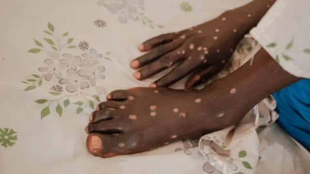 बुरुंडी में एमपॉक्स से पीड़ित एक व्यक्ति की तस्वीर