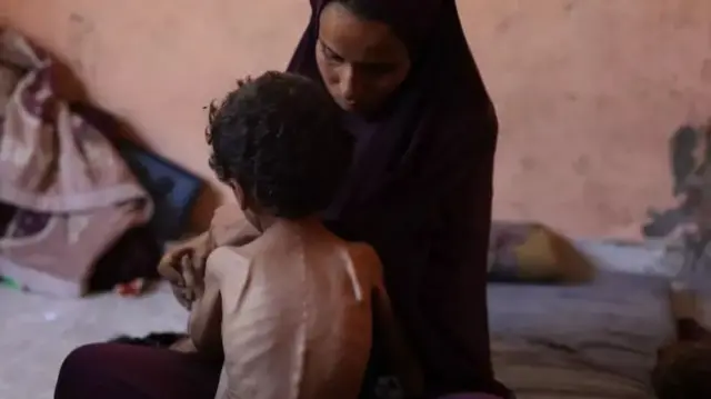امرأة وطفل يعاني سوء التغذية الحاد