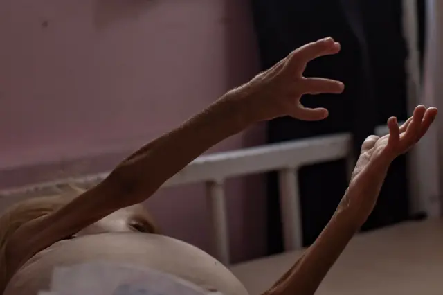 الطفلة الفلسطينية شام قديح (عامان) في مستشفى ناصر بخان يونس، جنوب قطاع غزة، في 10 أغسطس/آب 2025، وهي تعاني من سوء تغذية حاد