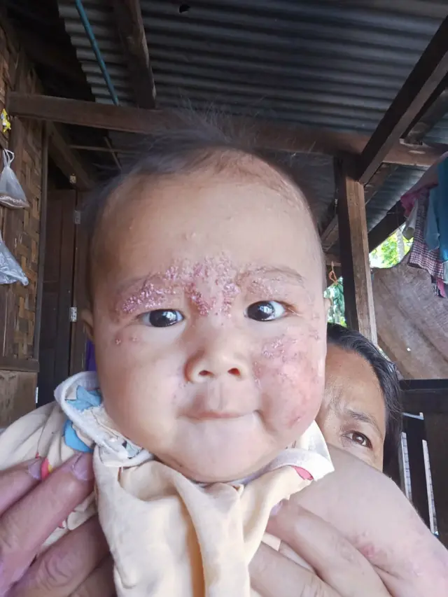 အရေပြားရောဂါကူးစက်ခံထားရတဲ့ ကရင်နီပြည်နယ်ထဲက ရှားတောမြို့နယ်မှာရှိတဲ့ စစ်ရှောင်စခန်းက ကလေးငယ်တစ်ဦး