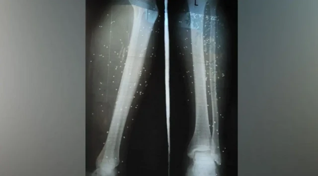 عکس رادیولوژی پای تارا؛ پزشک به او گفته است این ساچمه‌ها مثل ترکش‌های جنگ در بدنش می‌ماند