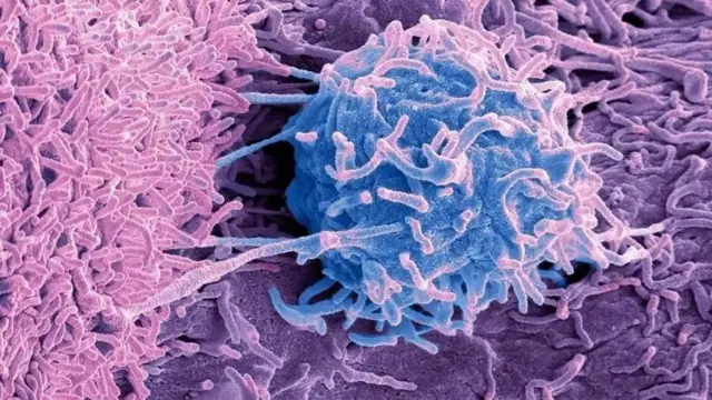 Bakteria na fungi pia huishi katika tumors.