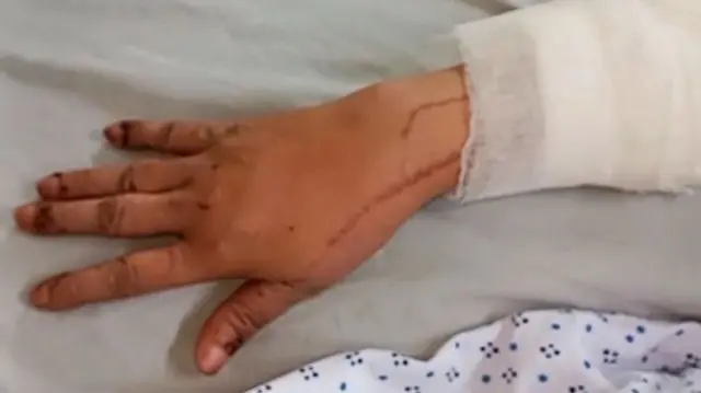 خاتون کا ہاتھ، جنھیں تیزاب حملے کا نشانہ بنایا گیا