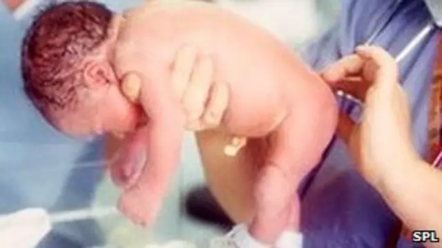 Qeysər kəsiyilə doğulan uşaq