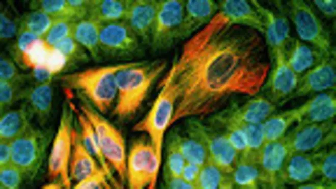 Células de piel cancerosas