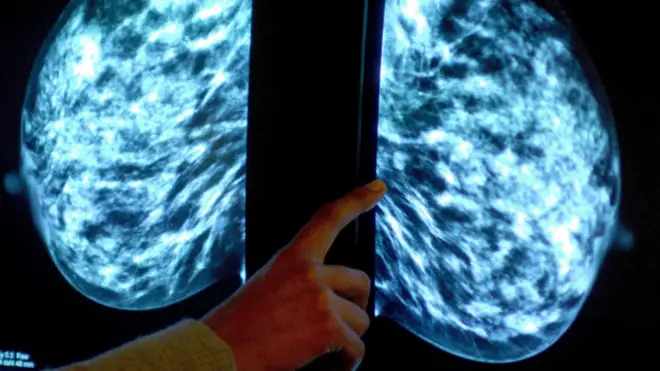 स्तन कैंसर