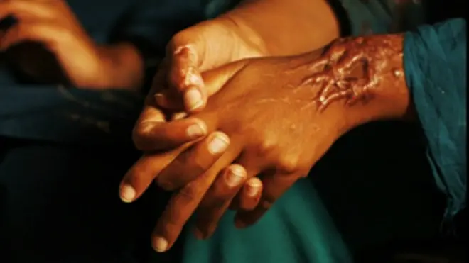 तेज़ाब पीड़िता