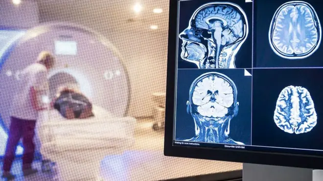 Cada vez hay más evidencia de que el covid-19 puede invadir el cerebro.