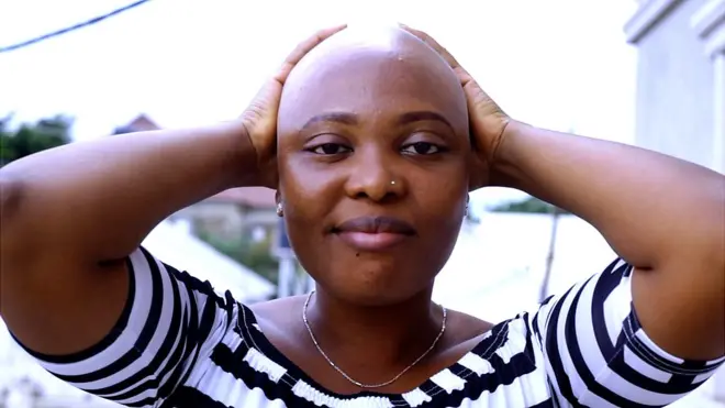 Alopecia