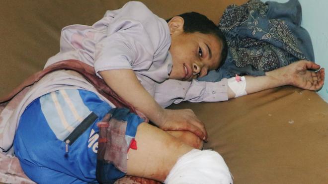 طفل يمني مصاب