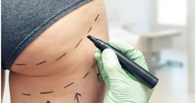 Aworan idi obinrin ti wọn fẹ se iṣẹ abẹ fun 