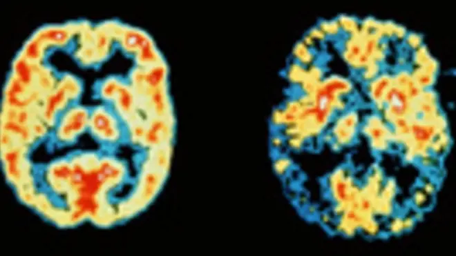 रिसर्चरों का दावा, रास्ता भूलना याद्दाश्त की बीमारी का सबसे शुरुआती लक्षण. वीडियो गेम पकड़ सकेगा बीमारी.