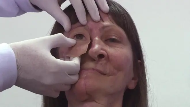 Rosto de mulher com prótese