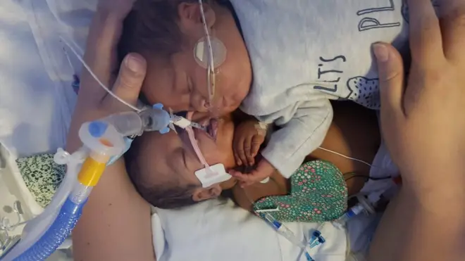 Deiniol and Dylan Zimunya were born 15 weeks early