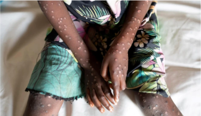 Mpox मुळे येणारा पुरळ