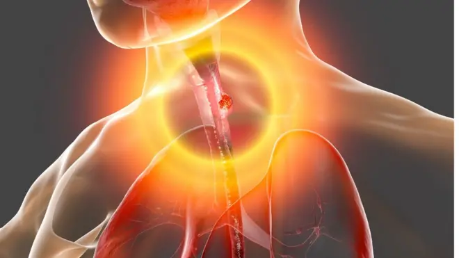 የጉሮሮ ካንሰር