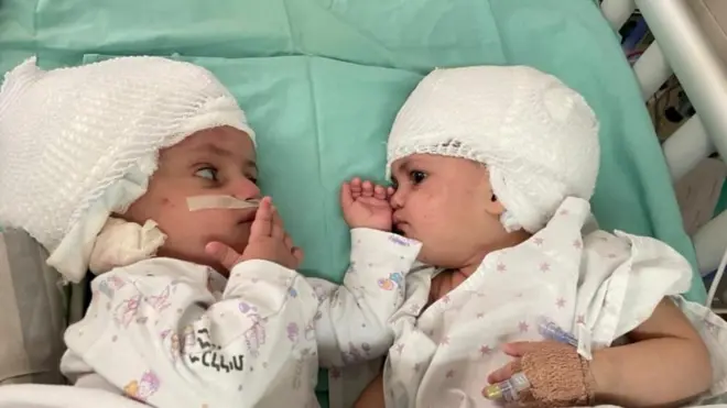 Sijamske bliznakinje