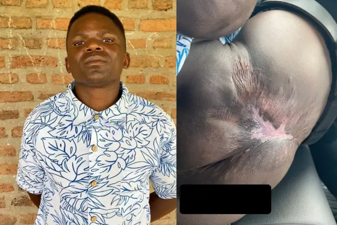 Inyama y'ikibuno cya Emmanuel Ndagijimana ku ruhande rumwe yarangiritse ku buryo bukomeye. Ku ifoto, ibumoso hari Emmanuel Ndagijimana yambaye ishati y'umweru n'ubururu ku rundi ruhande hari ifoto y'uruhande rumwe rw'ikibuno ahangiritse kubera iyicarubozo nk'uko abivuga. 