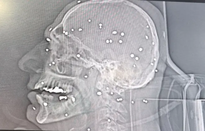 تصویر رادیولوژی صورت فردی که مورد اصابت ساچمه قرار گرفته است.