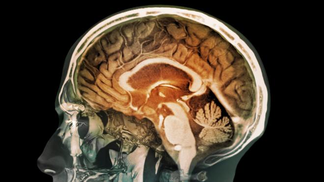 人脑MRI图像